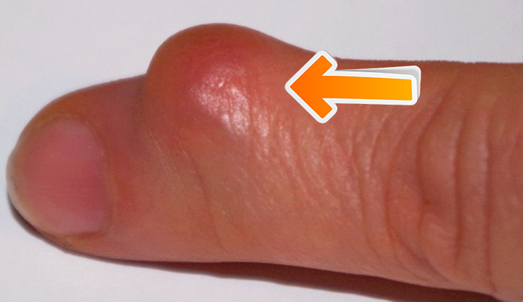 Knubbel am finger - 🧡 Hellbraune Flecken an den Fingern (Haut) .