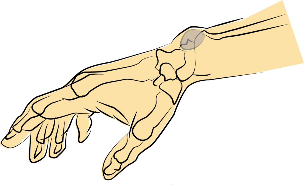 ganglion cyst on dorsal side of wrist